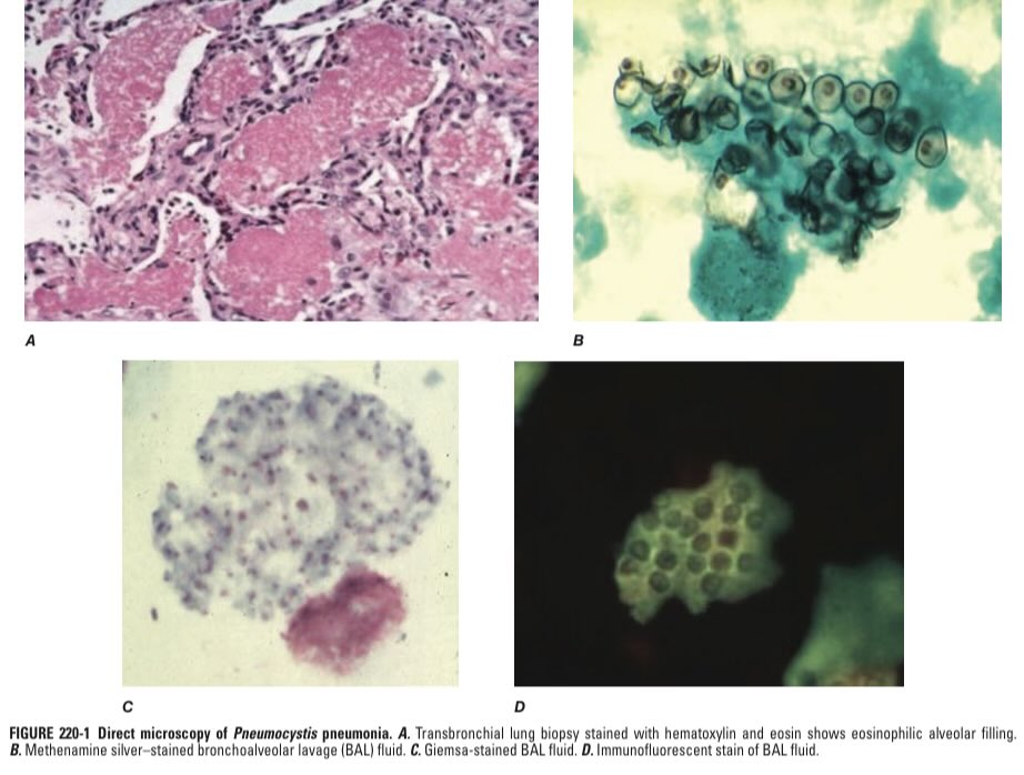 🦠 PCP Pneumonia
The infection every clinician must recognise early because a delay can be fatal.

Let’s break it down in the simplest and most practical way 👇
#MedTwitter #FOAMed #InternalMedicine

🔥 What is PCP
● Caused by Pneumocystis jirovecii
● A fungus that behaves