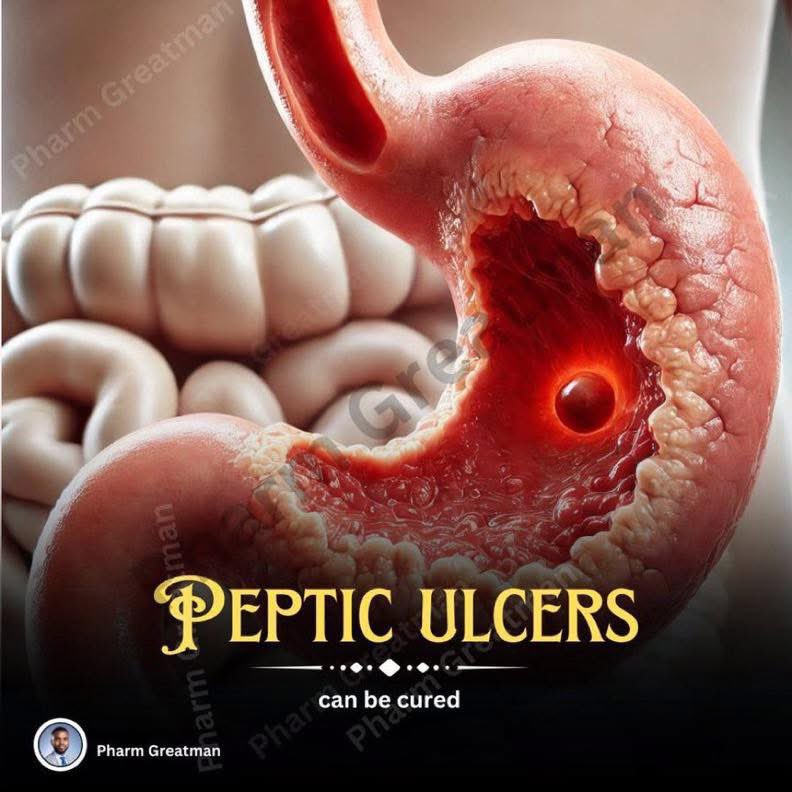 OGreat6's tweet image. PEPTIC ULCERS CAN BE CURED

You are not sentenced to a life of pain with peptic ulcer diagnosis; with the right steps, ulcers can heal completely.

This is the most comprehensive thread you&apos;ll read on peptic ulcers! 🧐 

Let’s dive in ✍🏽
A thread