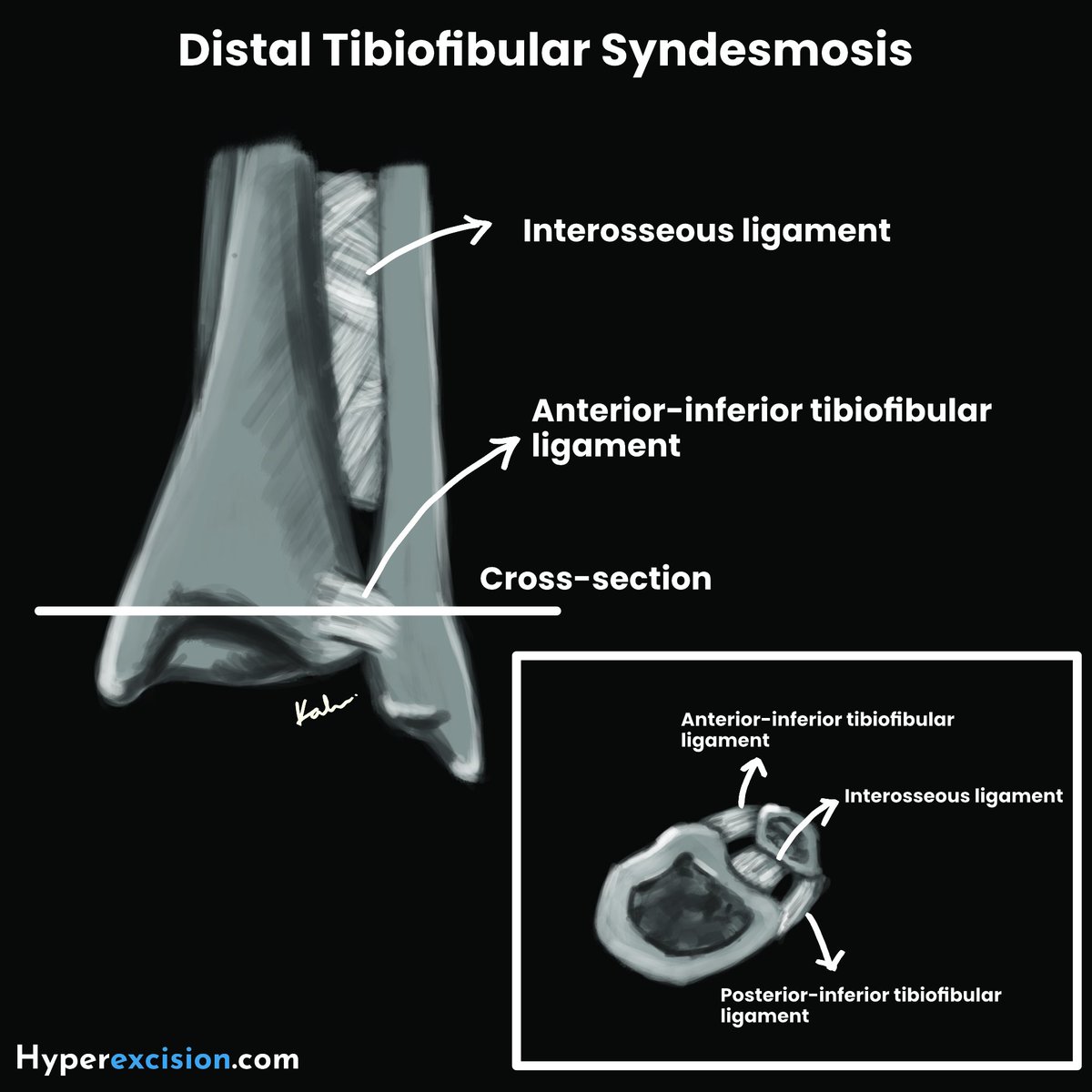 HyperExcision's tweet photo. The distal tibiofibular syndesmosis determines whether an ankle fracture is stable or unstable.

Injury to the AITFL, PITFL, or interosseous ligament → widened mortise → poor outcomes if missed.

Full ankle fracture guide → https://t.co/y83ikWzAmb
#Trauma #Medstudent https://t.co/cG5ESgBg67
