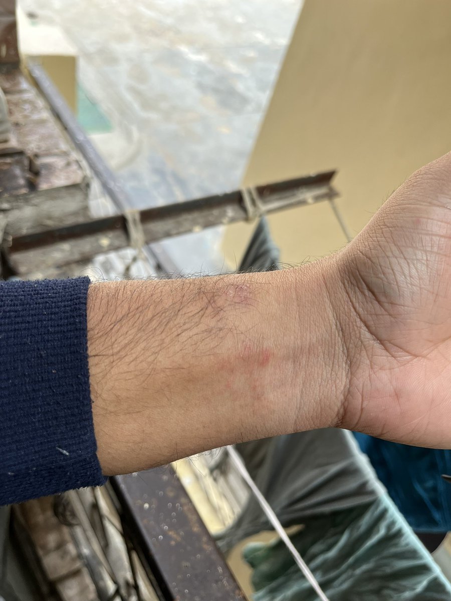ankit75329's tweet photo. I recently bought Series 11 @Apple watch, but since  I started wearing watch , I noticed rashes on my wrist and it's getting severe day by day🥲. Although it's super comfortable but when I take off the watch, I see severe rashes and bruises🥺. Don't know why it happening🥺 https://t.co/Pwp8oI0GID