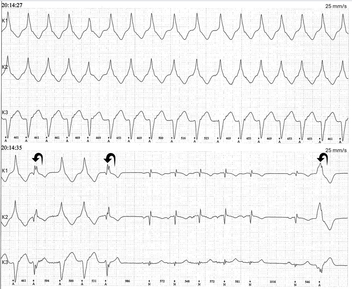 ecgandrhythmRoe's tweet image. 2 continuous Holter strips. Also for people who only like 12-lead ECGs. Rhythms? Please name the beats marked with arrows!