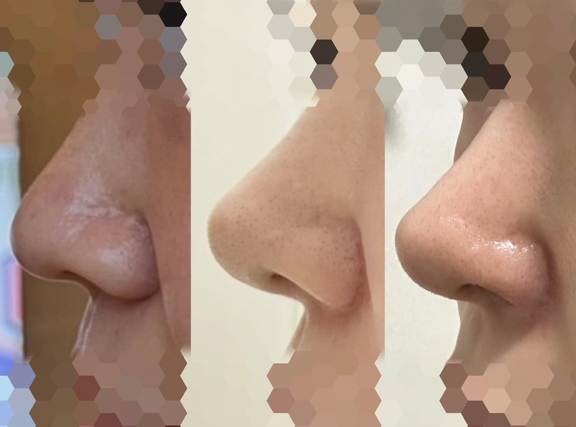 そうなんだよね、、私は鼻孔縁挙上の執刀医に、「小鼻が一体化して溶けてるみたい」にはしないでくださいって伝えた。それでカウセ資料も「小鼻の丸みは残して」って書いた📝あまりにも小鼻の存在感が無さすぎるのは不自然なんだよなー難しい