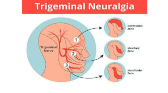 drsujoysanyal's tweet image. Effective Trigeminal Neuralgia Treatment in Kolkata: Compassionate Care, Modern Solutions - apsense.com/article/869147… 

#trigeminalneuralgia #trigeminalneuralgiaspecialist #trigeminalneuralgiatreatment #TrigeminalNeuralgiaAwareness #TheSuicideDisease #neurosurgeon #neurosurgery