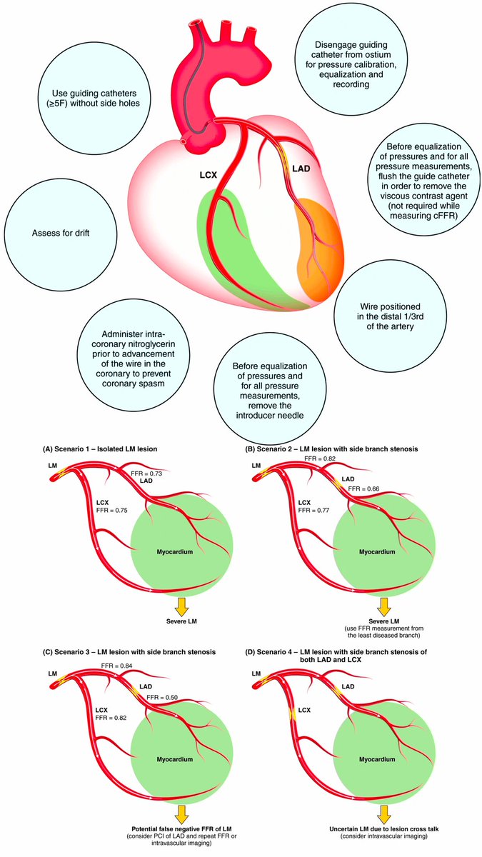 CardioBeat_'s tweet image. 📷 Just Published: Physiologic Assessment of Intermediate Coronary Lesions. facebook.com/share/p/19zhXo…
For the full evidence-based practices, dive into the AHA Scientific Statement:
spr.ly/604579znx

#Cardiology #CathLab #FFR #LeftMain #InterventionalCardiology #AHA