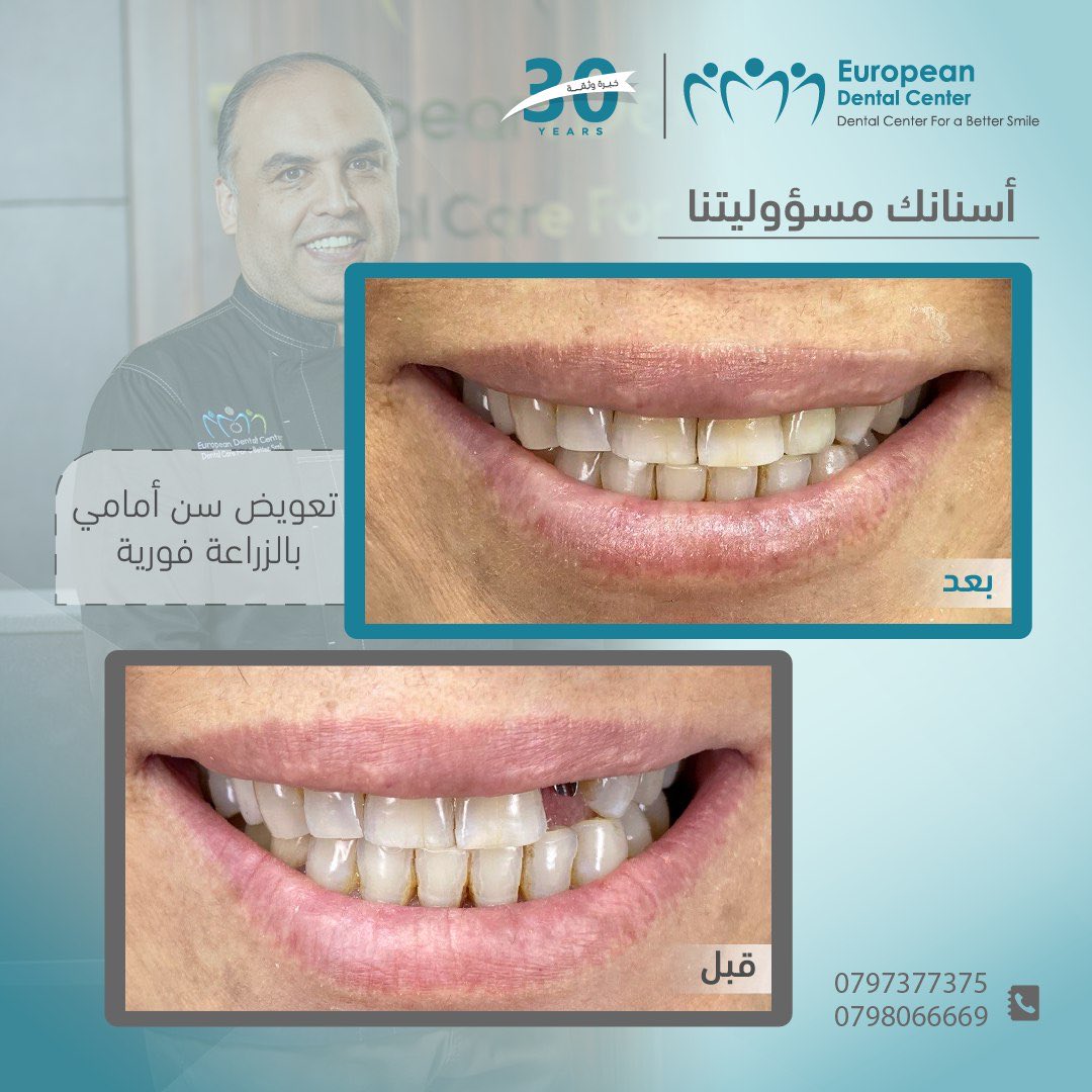 mohanadskiswani's tweet image. حالة زراعة فورية لسن أمامي تحت إشراف الدكتور مهند الكسواني 
تختلف الإجراءات الطبية وفقًا لكل حالة مريض، ويعتمد اتخاذ القرار المناسب لتجميل أسنانك للطبيب المعالج لحالتك 
يقرر الدكتور مهند الكسواني في المركز الأوروبي لطب الأسنان ما يناسبك وفق حالة أسنانك.
المركز الأوروبي لطب…