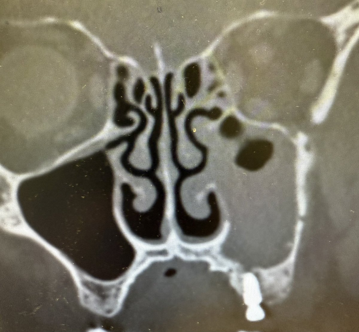 First case today. What will we find? Will the implant be okay? Was the #ODS there before or after implant? Hmmmm. Have nice Thursdays! <a href="/ent_ams/">Alberto Maria Saibene, MD, MA</a> <a href="/MartaKwiat_ska/">Marta Kwiatkowska, MD, PhD</a> <a href="/MakaryENT/">Chadi Makary, MD, MSc</a>