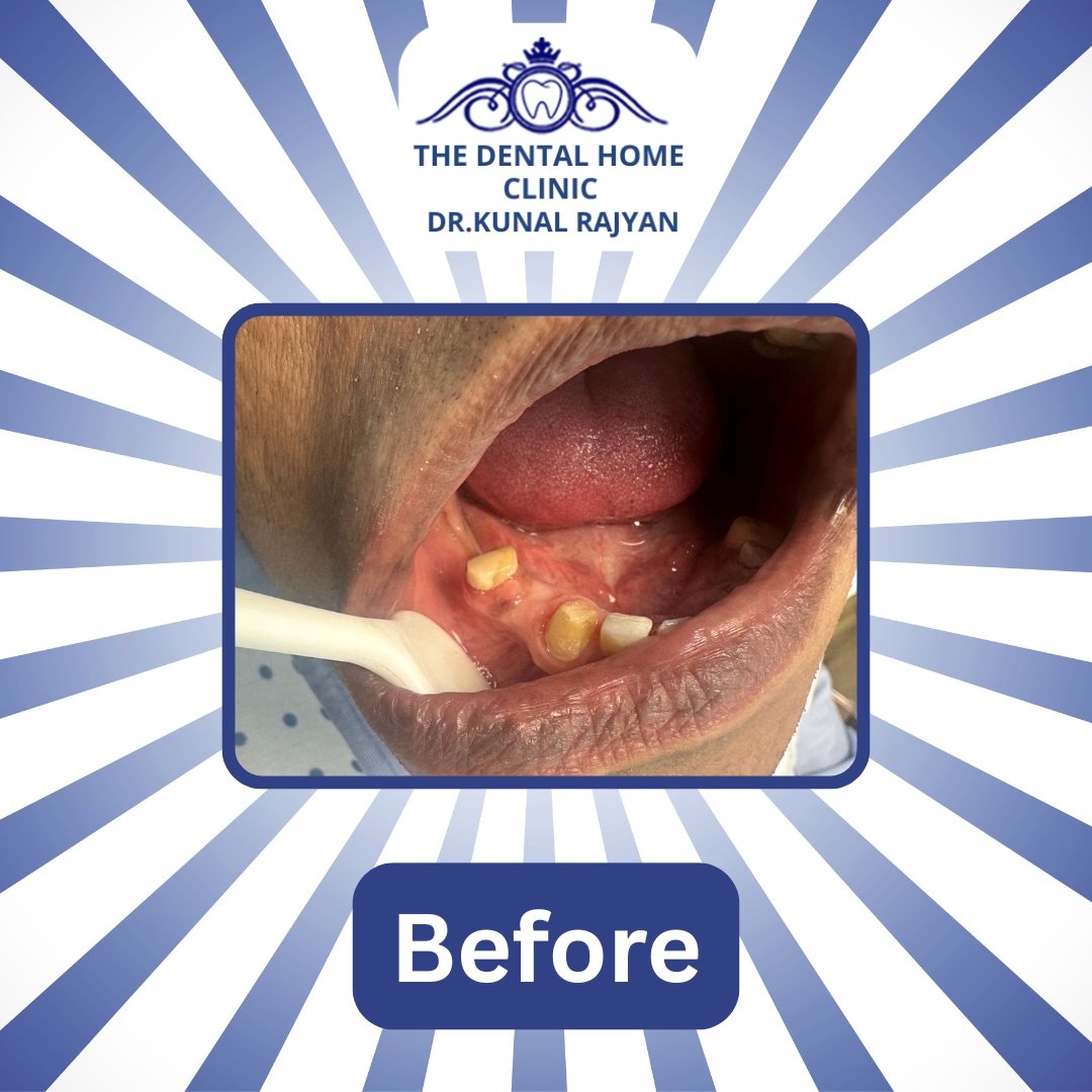 TheDentalHomeC1's tweet image. Transforming Smiles, Restoring Confidence! 
Experience life-changing Prosthesis Treatment at Dental Home Clinic — where science meets smile design in every transformation.
📞 +91-7428774577 | +91-9818351814 | 011-46046466
🌐 thedentalhome.in

#PerfectYourSmile #Prosthesis