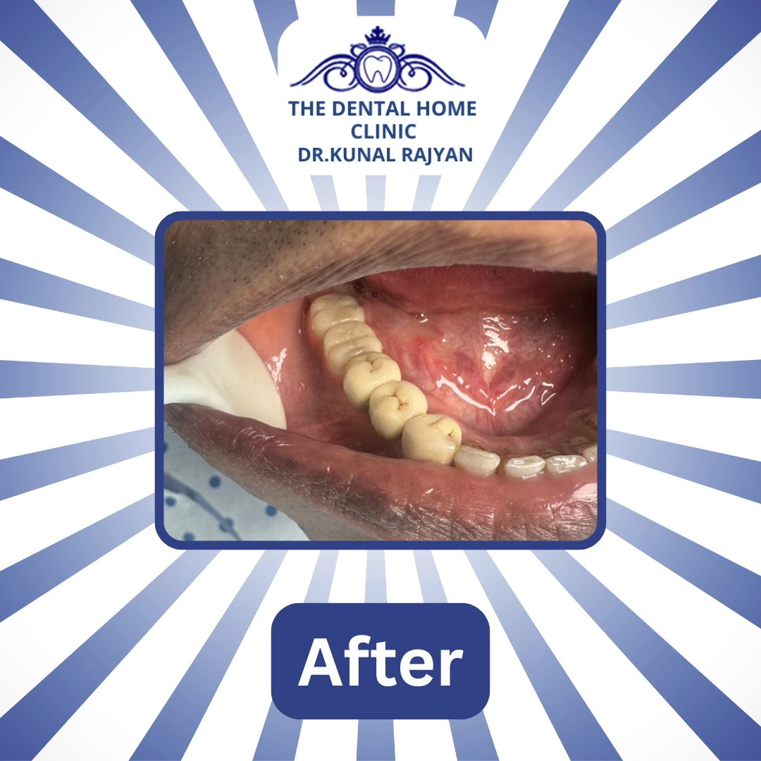TheDentalHomeC1's tweet image. Transforming Smiles, Restoring Confidence! 
Experience life-changing Prosthesis Treatment at Dental Home Clinic — where science meets smile design in every transformation.
📞 +91-7428774577 | +91-9818351814 | 011-46046466
🌐 thedentalhome.in

#PerfectYourSmile #Prosthesis