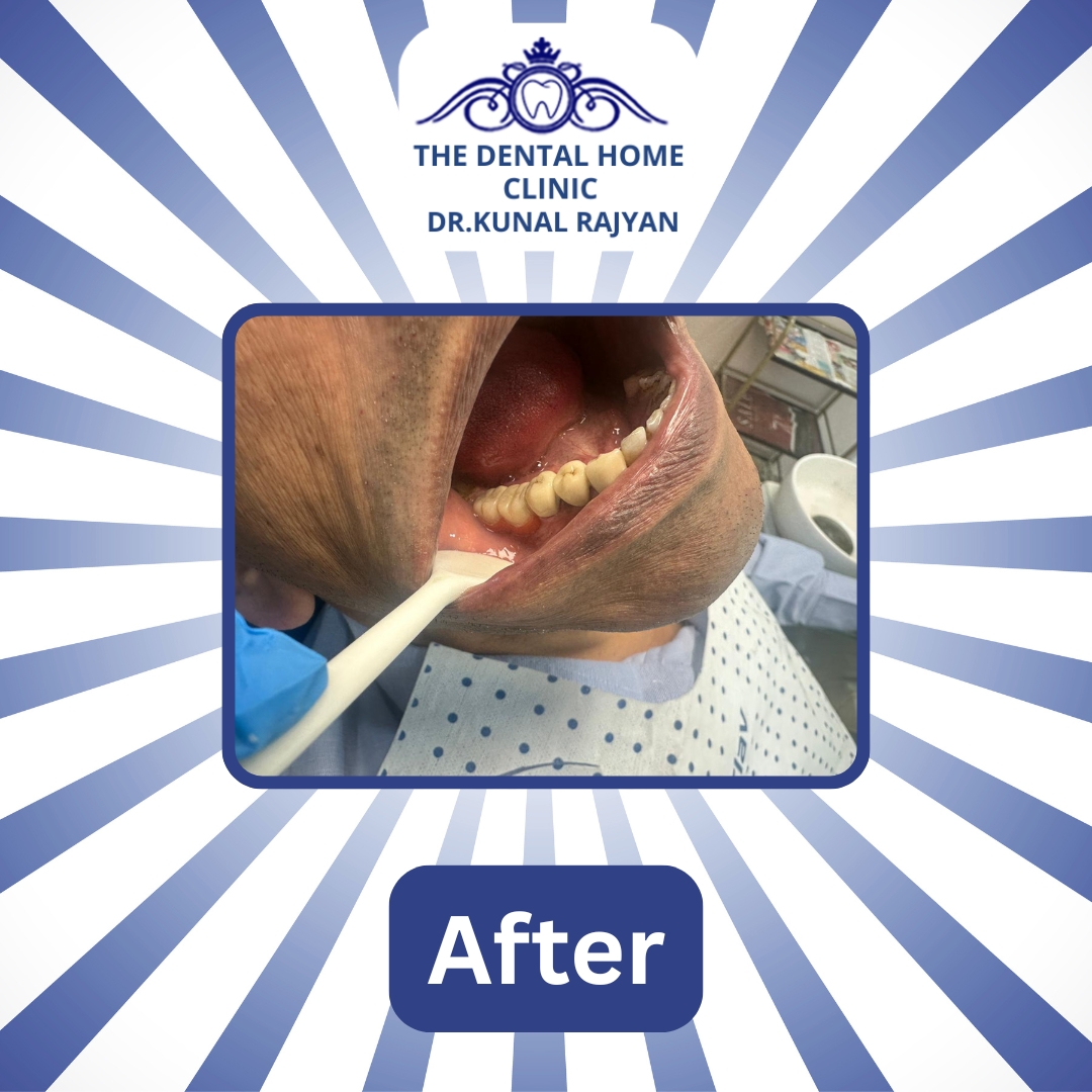 TheDentalHomeC1's tweet image. Transforming Smiles, Restoring Confidence! 
Experience life-changing Prosthesis Treatment at Dental Home Clinic — where science meets smile design in every transformation.
📞 +91-7428774577 | +91-9818351814 | 011-46046466
🌐 thedentalhome.in

#PerfectYourSmile #Prosthesis