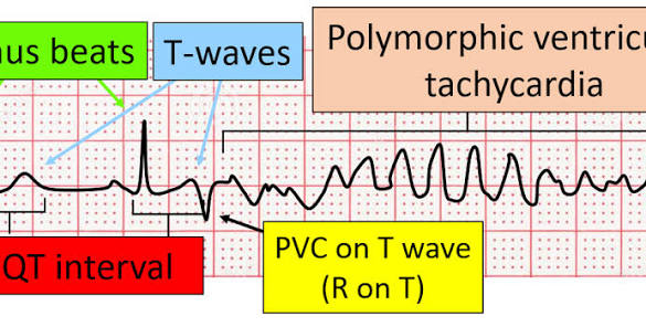 PeterItebimien's tweet photo. @DrAkhilX The "R on T" phenomenon is an ECG finding where a PVC,represented by its R wave,occurs during the T wave of the preceding beat. It is dangerous because it can fall during the heart's vulnerable repolarization phase,potentially triggering a life-threatening ventricular arrhythmia. https://t.co/uGAgZLd4pt