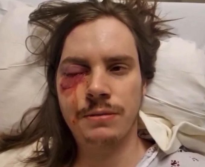 StandUpForTrmp's tweet image. 🚨BREAKING: This anti-ICE rioter was hit in the eye with a rubber bullet a couple months ago and is still suffering from vision loss. He is now preparing to file a lawsuit against the Trump administration because he feels he deserves justice for having to deal with such pain and…