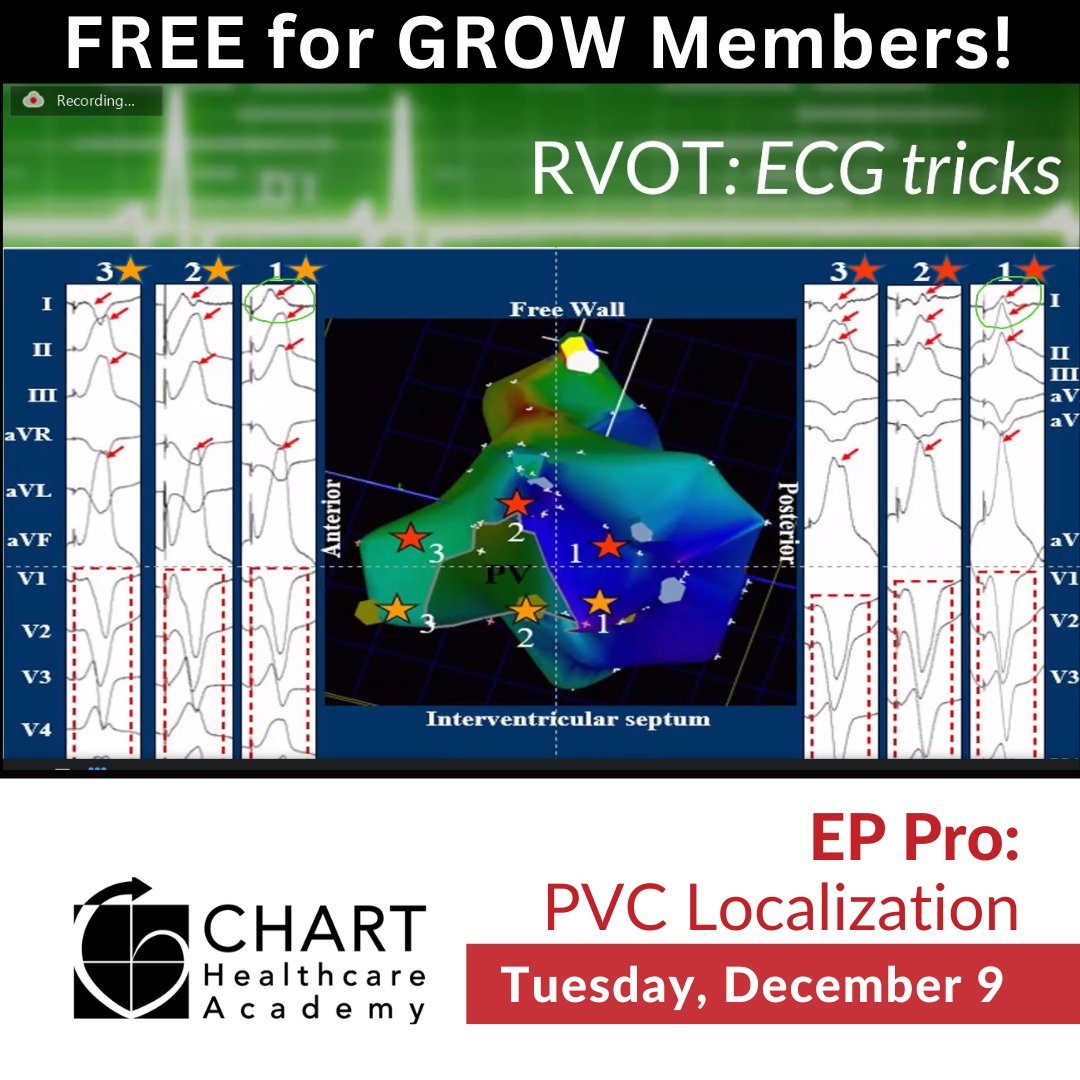 ChartAcademy's tweet image. 🎉 Every month we celebrate our learners with a powerhouse 90-minute virtual session - our EP Pro Courses! 

🔥 Final course in 2025! EP Pro: PVC LOCALIZATION! 🔥

Want in? bit.ly/4pj0Uqi

🚀 #CHARTpeeps #EPeeps #VivaEP #CHARTEPPro #GROWMembership #MedTech  #EPCurious
