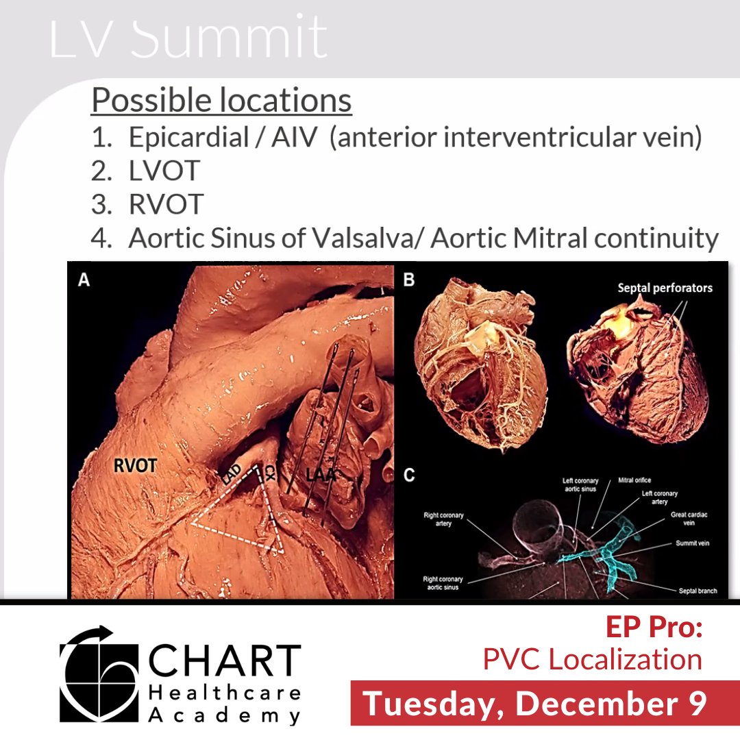 ChartAcademy's tweet image. 🎉 Every month we celebrate our learners with a powerhouse 90-minute virtual session - our EP Pro Courses! 

🔥 Final course in 2025! EP Pro: PVC LOCALIZATION! 🔥

Want in? bit.ly/4pj0Uqi

🚀 #CHARTpeeps #EPeeps #VivaEP #CHARTEPPro #GROWMembership #MedTech  #EPCurious