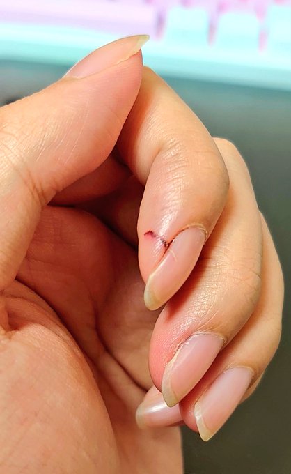 ちなみに傷はこんな感じになってます
痛そう 