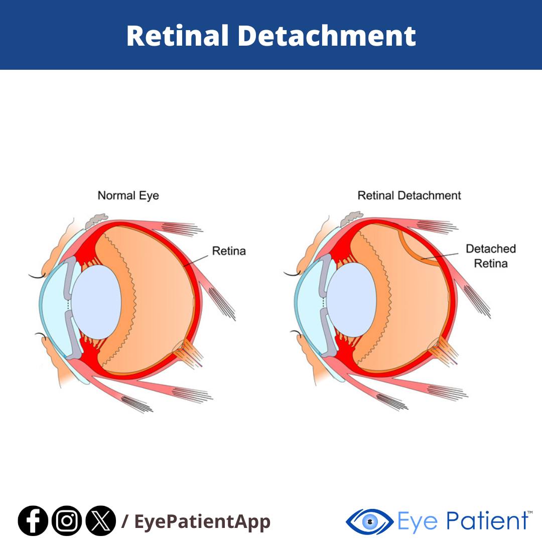 EyePatientApp's tweet image. Retinal Detachment | #Free Eye Patient App To learn more about your eyes, monitor your vision, and find an eye doctor near you download the Eye Patient app (available on Android &amp;amp; iOS): onelink.to/eyepatientapp #EyeCare #RetinalDetachment #colourblindnes #colorblind #eyetest