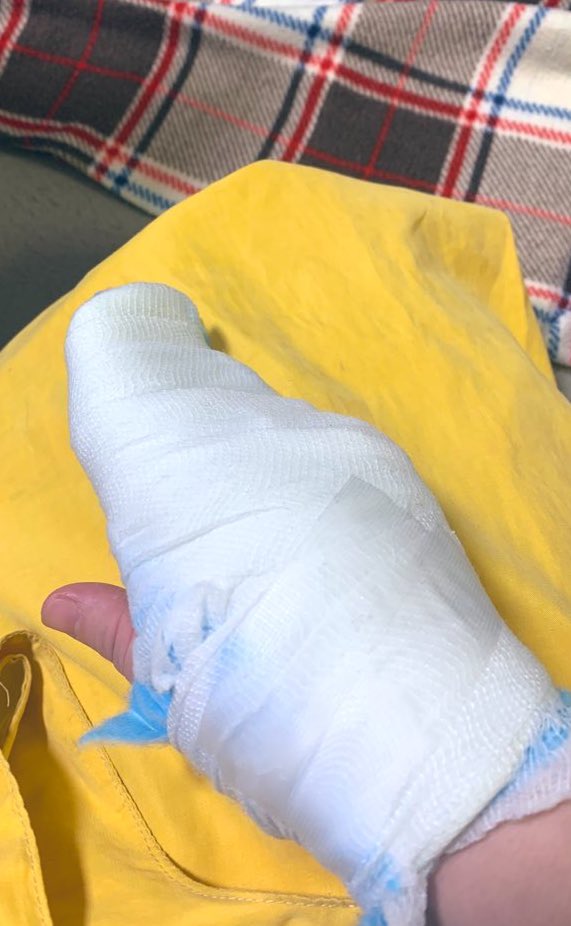 0182PM's tweet photo. 焼く前のクロワッサン🥐
先生👨‍⚕️不器用すぎん？

（掌側板剥離骨折 11/15～） https://t.co/PXvnFPMTcD