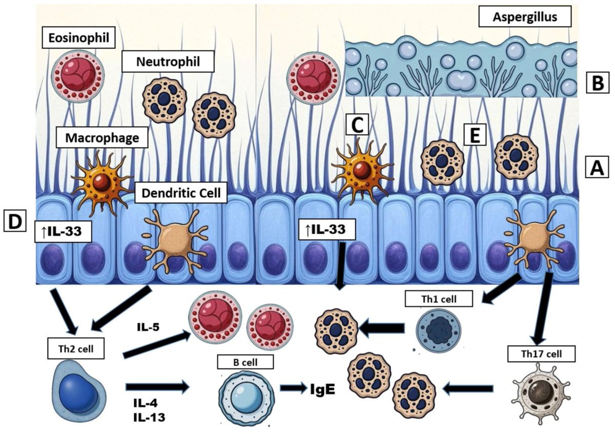 JoR_Mdpi's tweet image. #NewlyPublished  

✨ 𝑰𝒎𝒎𝒖𝒏𝒐𝒍𝒐𝒈𝒚 𝒂𝒏𝒅 𝑩𝒊𝒐𝒍𝒐𝒈𝒊𝒄𝒔 𝒊𝒏 𝒕𝒉𝒆 𝑻𝒓𝒆𝒂𝒕𝒎𝒆𝒏𝒕 𝒐𝒇 𝑨𝒍𝒍𝒆𝒓𝒈𝒊𝒄 𝑩𝒓𝒐𝒏𝒄𝒉𝒐𝒑𝒖𝒍𝒎𝒐𝒏𝒂𝒓𝒚 𝑨𝒔𝒑𝒆𝒓𝒈𝒊𝒍𝒍𝒐𝒔𝒊𝒔 𝒊𝒏 𝑪𝒚𝒔𝒕𝒊𝒄 𝑭𝒊𝒃𝒓𝒐𝒔𝒊𝒔

📖 mdpi.com/2673-527X/5/4/…

#JoR #OpenAccess #CysticFibrosis