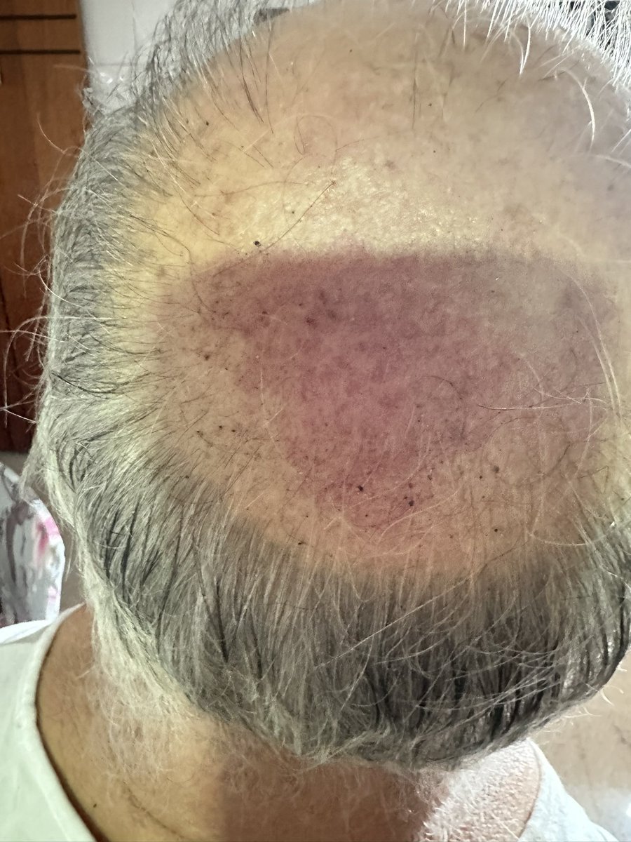 brunacm's tweet image. MEU PAI FOI AGREDIDO PELA POLÍCIA MILITAR NA FRENTE DA AGRIZONE
Um batedor da PM não me permitiu parar para que meus pais IDOSOS e com DIFICULDADE DE LOCOMOÇÃO entrassem no carro
Um militar SOCOU o carro e, quando meu pai ia entrar no carro, ele EMPURROU MEU PAI, QUE CAIU NO CHÃO