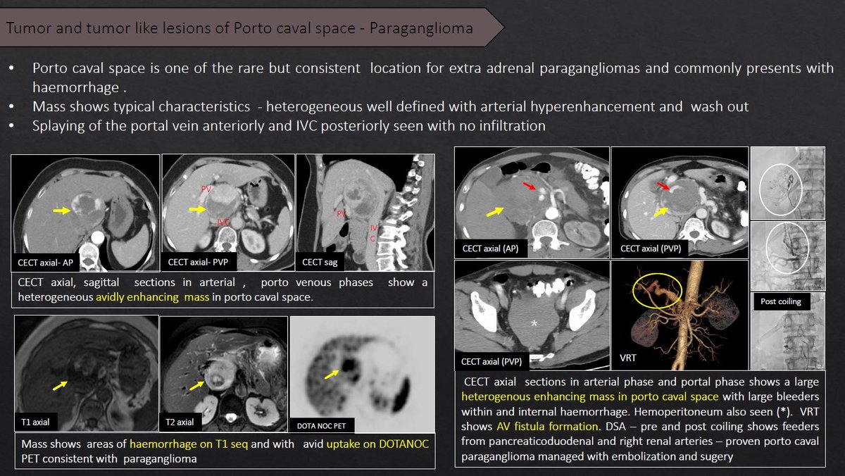 YashantAswani's tweet photo. Let’s learn about Portacaval space pathologies @RSNA #RSNA2025 @anurp269090
@rajeshvhelavar @radRounds #radiology #bodyrad #radres #radtwitter #portacaval #hepaticartery #variantanatomica #surgicalanatomy #internalhernia #epiploicforamen https://t.co/6MwJJ7QeMN