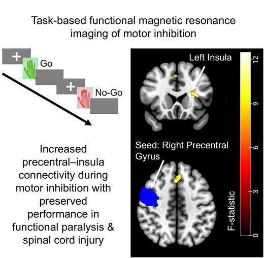 braincomms's tweet image. Vallesi et al. report that individuals with functional paralysis and spinal cord injury show similar increases in functional connectivity between the right precentral gyrus and left insula during motor inhibition, despite intact behavioural performance 👉 buff.ly/wNl4YZE