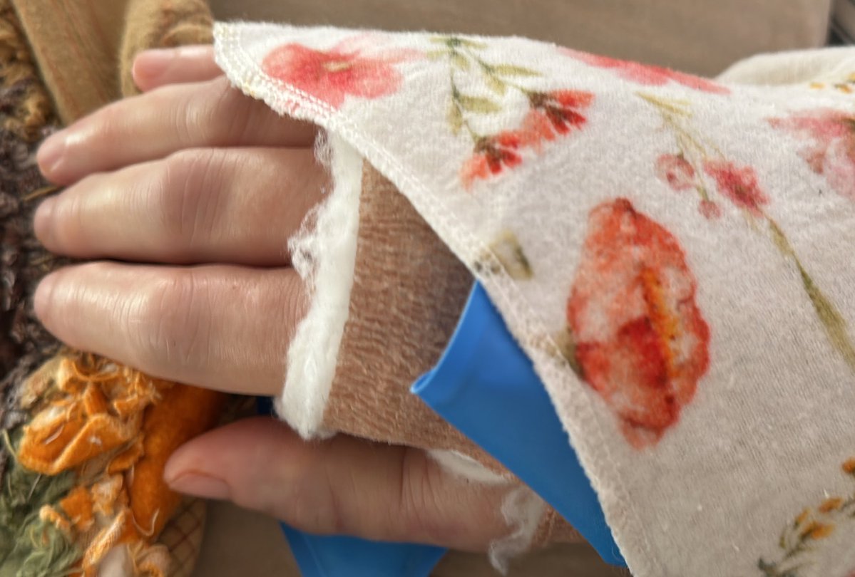 DrLectersMask's tweet image. This is what rheumatoid arthritis looks like on Obamacare. Any questions? 
All of the bones, the carpal bones, in my hand are gone. Essentially, the part of my hand that is next to the wrist bone collapsed and jammed backward and underneath my wrist bone. The distal end of my…