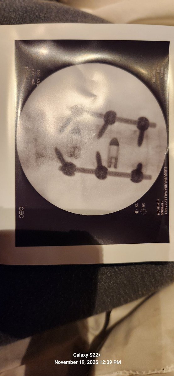 zether's tweet image. Pretty pic of the #hardware in my #spine. That bubble on top is the needle entering my spinal column. Every 3 months just to have reduced pain and swelling so I can walk instead of being dependant on a wheelchair and the swelling wont crush my spinal cord. exactly like Luigi&apos;s