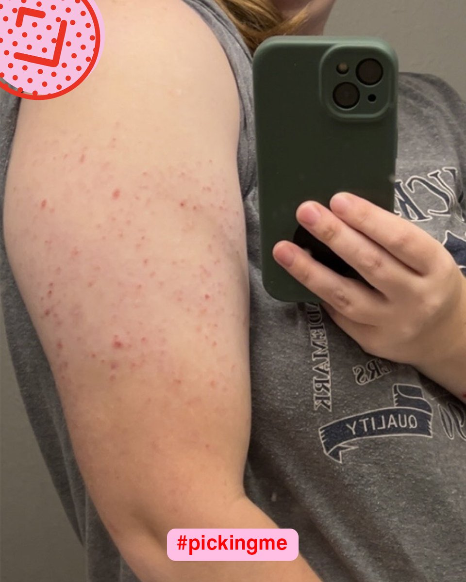 PickingMeFdn's tweet image. &quot;I&apos;m #PickingMe over #SkinPicking I deserve to live a healthy and happy life without being insecure to my skin&apos;s appearance.&quot; - Riley, 24, GA

Can you relate to Riley&apos;s experience? Read more stories and share your own at pickingme.org/shareyourstory 💖