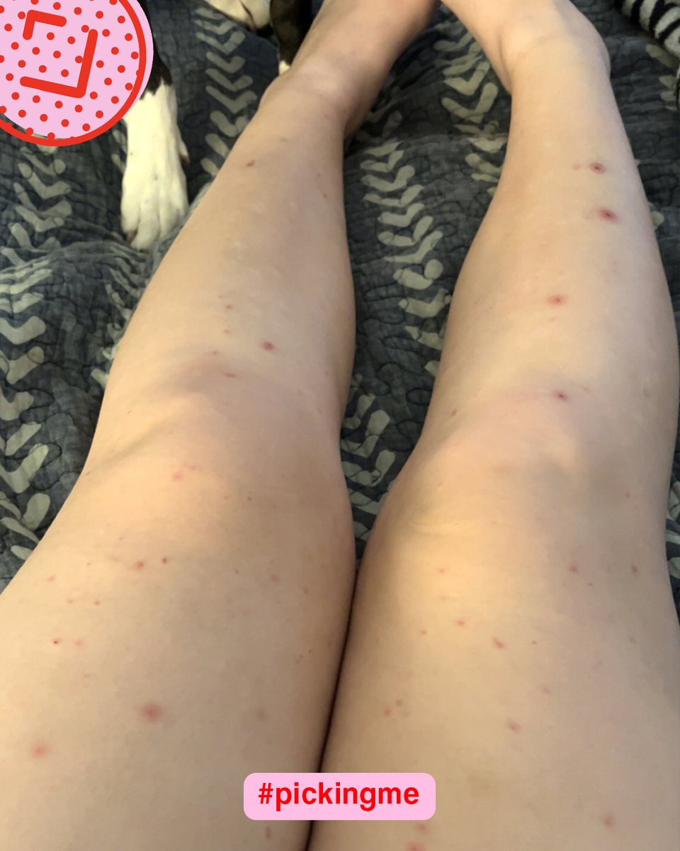 PickingMeFdn's tweet image. &quot;I&apos;m #PickingMe over #SkinPicking I deserve to live a healthy and happy life without being insecure to my skin&apos;s appearance.&quot; - Riley, 24, GA

Can you relate to Riley&apos;s experience? Read more stories and share your own at pickingme.org/shareyourstory 💖