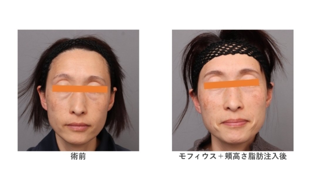 theclinic_abe's tweet image. 第50回モフィウス プレゼント
美容業界ではオペが軽すぎます。
本来神聖であり、お互い覚悟がいる行為です。
モフィウスが広まり、オペで泣く人を１人でも少なくしたい。
今回は「モフィウス目の下クマ」を5名に無料プレゼントします。
このアカウントフォローしてリポスト、いいねで応募できます。