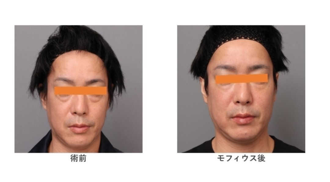 theclinic_abe's tweet image. 第50回モフィウス プレゼント
美容業界ではオペが軽すぎます。
本来神聖であり、お互い覚悟がいる行為です。
モフィウスが広まり、オペで泣く人を１人でも少なくしたい。
今回は「モフィウス目の下クマ」を5名に無料プレゼントします。
このアカウントフォローしてリポスト、いいねで応募できます。