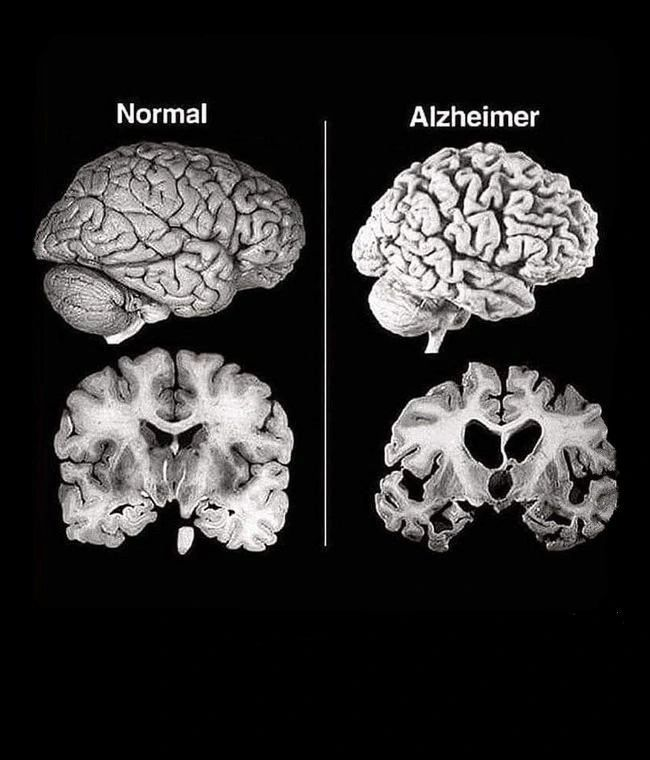 NOgymNOlimits's tweet photo. El Alzheimer no empieza cuando aparece.

Empieza años antes, en silencio.

Y aunque no todo depende de ti, (la genética importa), sí puedes reducir el riesgo con tus hábitos diarios.

Quizá sea porque es un tema que por desgracia me viene tocando sufrir cada día desde hace tiempo,...

por lo que creo que al menos, deberíamos tratar de hacer todo lo que esté en nuestra mano por prevenirlo.

Aunque como digo, la genética es un factor clave...

tu cerebro no es algo fijo.

Es plástico. Adaptable. Reparable.

Pero también vulnerable a todo lo que haces (o dejas de hacer).

Aquí van 8 cosas que deterioran tu mente y cómo evitarlas (con ciencia):

1. Dormir mal.

Mientras duermes, el sistema glinfático elimina toxinas como la beta-amiloide.
Dormir poco = peor limpieza cerebral → mayor riesgo de Alzheimer
(Science, 2013).

Solución:
Rutina fija, oscuridad total, cero pantallas 1h antes, cenas ligeras 2h antes.

2. No entrenar.
El ejercicio estimula la neurogénesis y protege el hipocampo (memoria).
Moverte es prevención neurodegenerativa
(PNAS, 2011; PNAS, 2018).

Solución:
Camina cada día. Fuerza 2–3x por semana. Hazlo por tu mente, no solo por tu cuerpo.

3. Comer basura.
Ultraprocesados → inflamación crónica + estrés oxidativo.
Ambos aceleran deterioro cognitivo y envejecimiento cerebral
(Clin Interv Aging, 2015).

Solución:
Comida real. Proteína, grasas buenas, fibra. Orden y saciedad. Lo básico.

4. Azúcar alta y metabolismo deteriorado.
La resistencia a la insulina aumenta el riesgo de Alzheimer.
Ya la llaman “diabetes tipo 3”
(Neurology, 2012).

Solución:
Evita el picoteo. Camina tras las comidas. Entrena. Estructura.

5. Estrés crónico.
El cortisol elevado daña neuronas del hipocampo y afecta memoria, emociones y toma de decisiones
(Nat Rev Neurosci, 2009).

Solución:
Respira. Camina al sol. Medita. Baja el volumen del mundo 30 minutos al día.

6. Falta de conexión humana.
El aislamiento social incrementa el riesgo de deterioro cognitivo y demencia
(Ageing Res Rev, 2015).

Solución:
Relaciónate. Conversa. Ríe. No sustituyas vínculos con scroll. El cerebro necesita contacto real.

7. Pensamientos negativos repetidos.
El diálogo interno persistente y tóxico se asocia a mayor acumulación de beta-amiloide
(Alzheimer’s Dement, 2020).

Solución:
Cuestiónalos. Escríbelos. Cámbialos. Háblate como hablarías a alguien que quieres.

8. Falta de propósito.
Un cerebro sin dirección se apaga.
Tener un "para qué" protege funciones ejecutivas y retrasa el deterioro
(Arch Gen Psychiatry, 2010).

Solución:
Define un objetivo. Avanza un paso al día. Vive con intención, no en piloto automático.

Conclusión.
No puedes evitar envejecer.
Pero sí puedes evitar apagar tu mente en el proceso.

Cuídala hoy.
Porque mañana puede ser tarde.

✉️ Únete a mi newsletter para más contenido basado en ciencia para mejorar tu salud, hábitos y mentalidad.

Casi 2.600 personas ya están dentro: https://t.co/yWeRoa7Ive

Hugo.

Referencias: Science (2013) – sistema glinfático y sueño PNAS (2011, 2018) – ejercicio y neuroprotección Clin Interv Aging (2015) – fuerza y prevención cognitiva Ann Neurol (2006) – dieta mediterránea y Alzheimer Neurology (2012) – insulina y “diabetes tipo 3” Nat Rev Neurosci (2009) – estrés y daño hipocampal Ageing Res Rev (2015) – aislamiento y demencia Alzheimers Dement (2020) – pensamientos negativos y amiloide Arch Gen Psychiatry (2010) – propósito vital y cognición