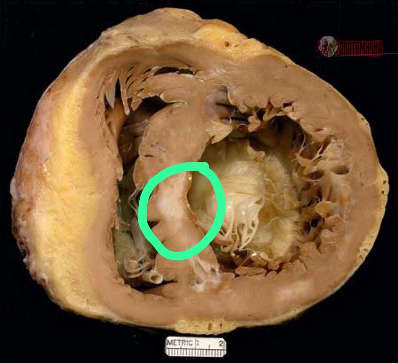 IhabFathiSulima's tweet image. A Patient with Cardiomyopathy died.
What is the diagnosis⁉️
What is the Circled lesion ⁉️