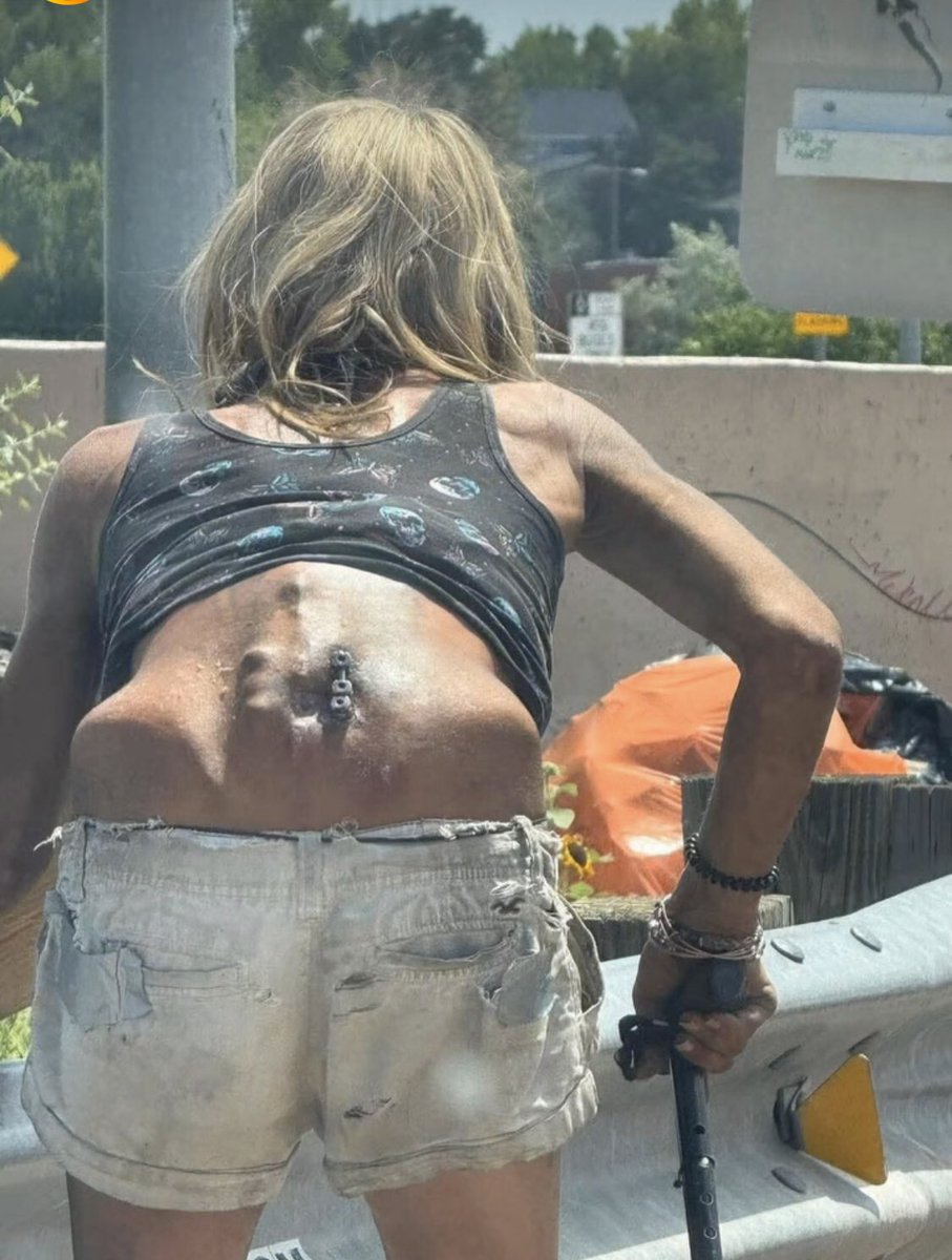 Sage_medics's tweet image. This is an older lady with a metal spinal fixation hardware (screws and possibly rods) protruding through the skin on the lumbar spine. 

These screws are externally visible, which is not normal and strongly indicates a serious post-surgical complication.💔🤕