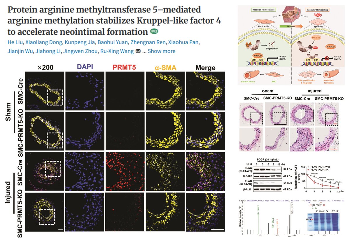 HaoYin20's tweet image. PRMT5 methylates &amp;amp; stabilizes KLF4 protein▶️
⏫#SmoothMuscleCell proliferation/migration &amp;amp; intimal hyperplasia in injured🐭carotid artery

Evidence from #SmoothMuscleCell PRMT5 KO🐭 &amp;amp; Lentiviral PRMT5

PRMT5⬆️ in👤carotid stenosis &amp;amp; PDGF-BB-treated SMC

#CardioVascRes 2023…