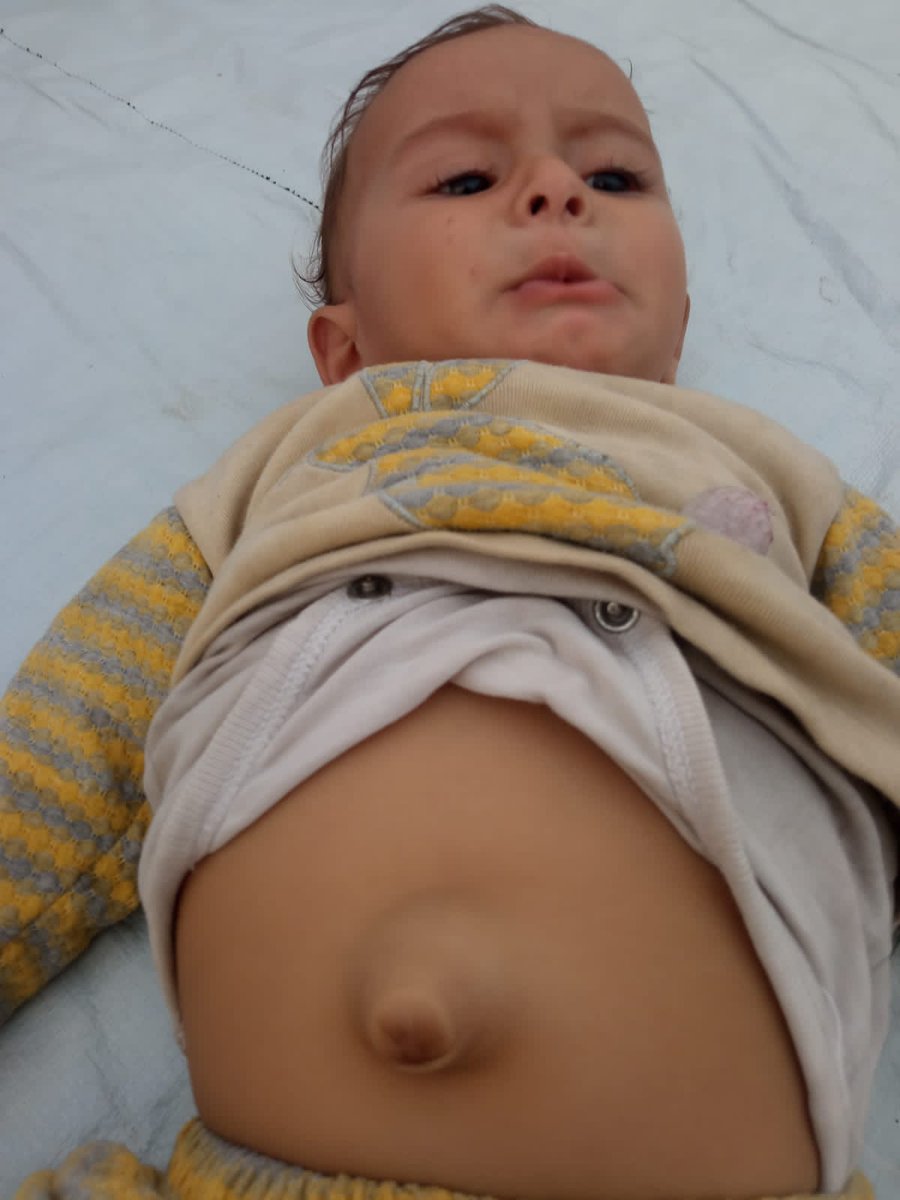 alaa_hamdona's tweet image. ‼️3 days without donations 💔
My sister’s baby is suffering from *malnutrition* and* umbilical condition*.
He urgently needs milk, nutritional supplements, and medical care.  

We fully depend on your kind support.
*Please, help us care for this innocent child.*
🔗 in comments👇