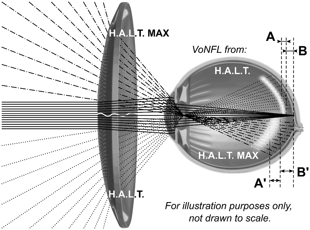 revoptom's tweet image. Second-Gen Stellest Lens More Effective in Slowing AL Elongation, Study Shows

Currently in early stages of development, the new design uses higher-power lenslets to reduce peripheral retinal contrast.
reviewofoptometry.com/article/second…
#myopia #myopiacontrol #eyecare #optometry #essilor