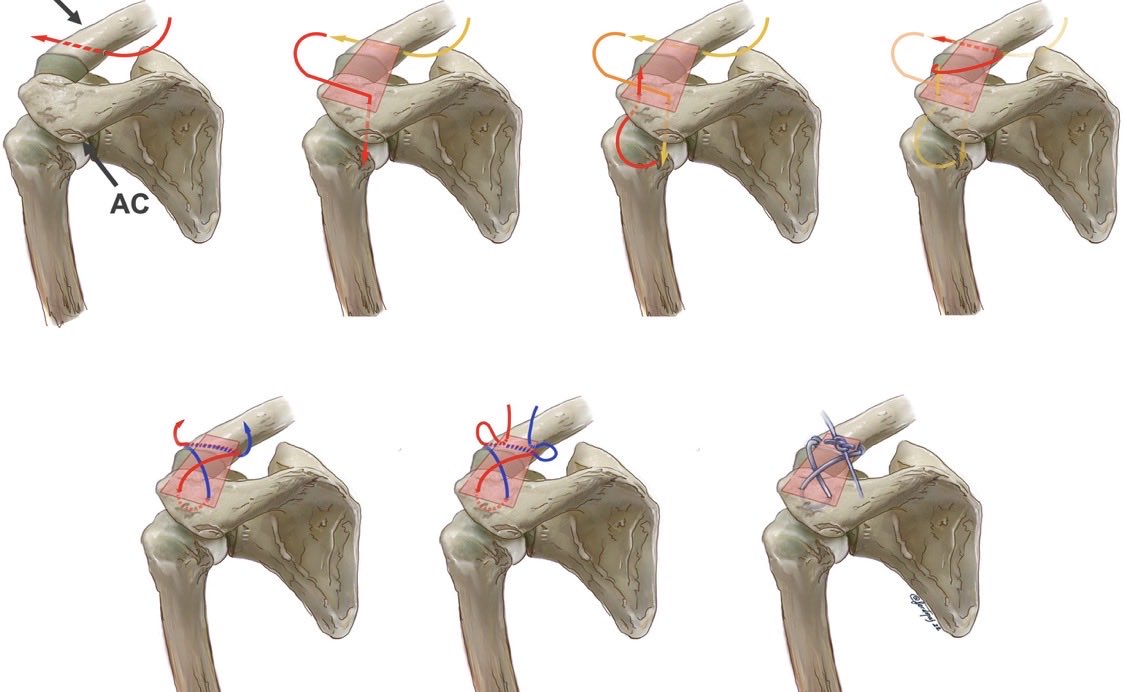 A-C joint orthopedic surgery repair.
