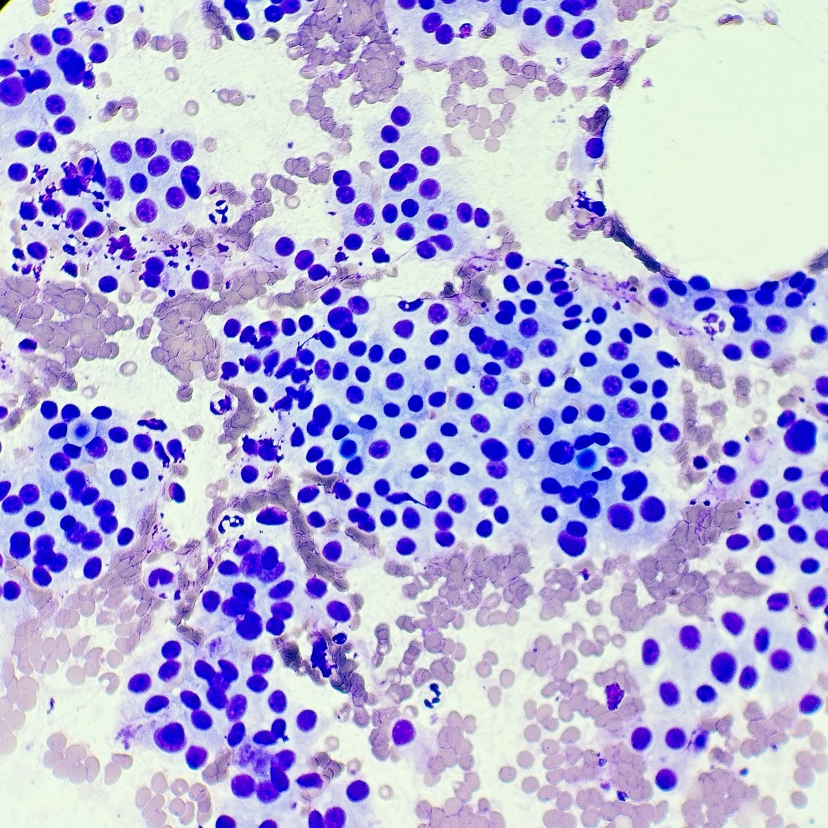 Thyroid FNA: Bethesda Category IV
Follicular neoplasm (oncocytic)

Highly cellular smears composed almost entirely of oncocytic cells.

#PathTwitter #MedTwitter #CytoPath #Cytology #ThyroidFNA #CytoFellow