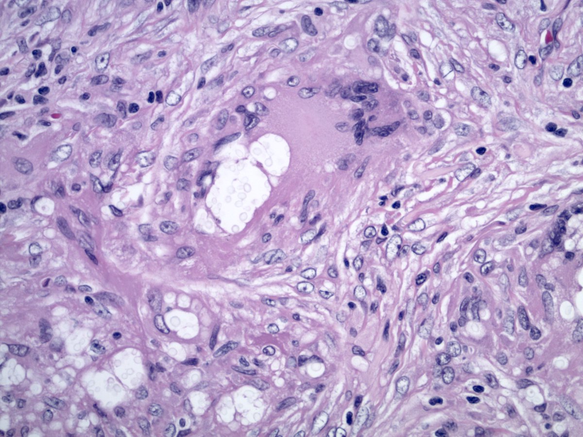 smlungpathguy's tweet image. 3. Classic cryptococcosis, case 5, Table 1

It was called Cryptococcus on morphology, subsequently confirmed by cultures. No need to hedge if yeast with classic morphology!

Reference:
journals.sagepub.com/doi/10.1177/10…