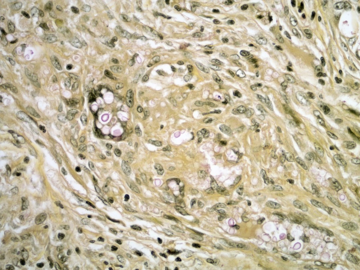 smlungpathguy's tweet image. 218/
Image from case 5, table 1, Toro P, et al, Int J Surg Pathol 2025
journals.sagepub.com/doi/10.1177/10…

Mucicarmine is positive in pleomorphic yeasts with a halo. Hedge or diagnose as Cryptococcus?

#pathbugs #crittersontwitter