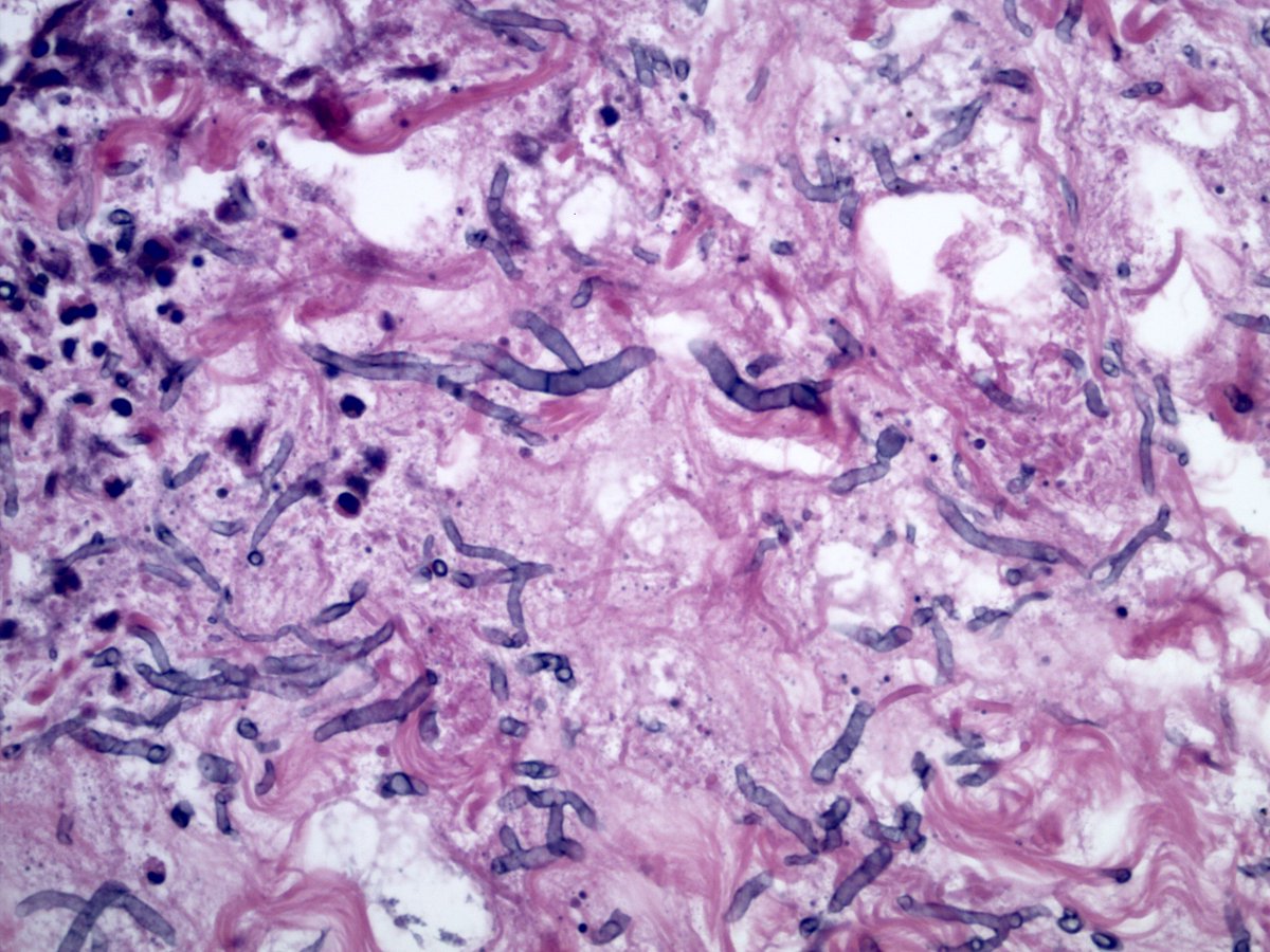 smlungpathguy's tweet image. 5. Now this one is tricky. Most fungi that look like this in the lung turn out to be Aspergillus. But there are a few exceptions, so ok to hedge 

Image from case 30, table 1, Toro P et al, Int J Surg Pathol 2025
journals.sagepub.com/doi/10.1177/10…

#pathbugs #crittersontwitter