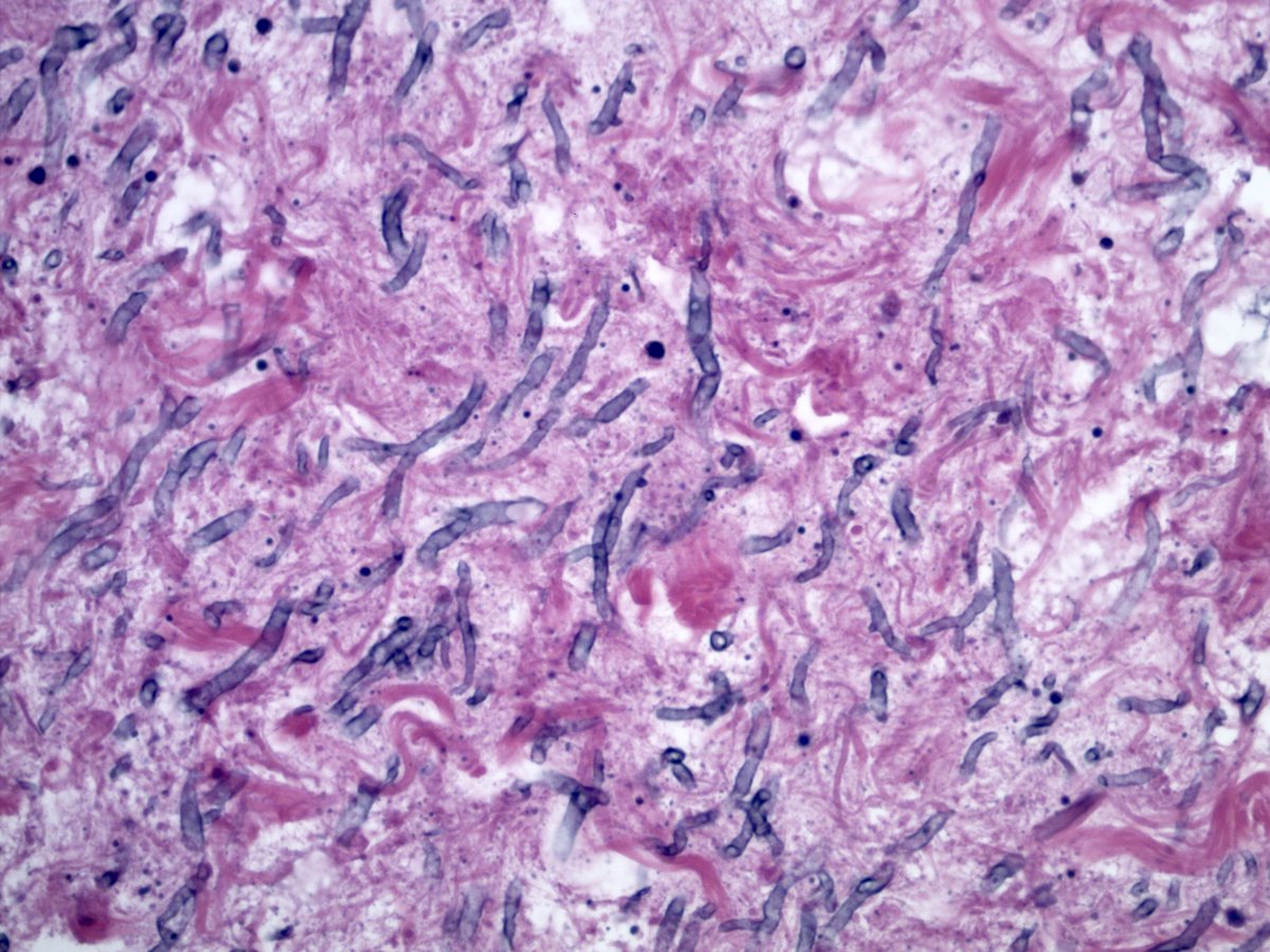 smlungpathguy's tweet image. 6. These questions have no easy answer. How much risk is involved in calling fungi like this Aspergillus in the lung? How often are we wrong? What are the clinical consequences?

See discussion here:
journals.sagepub.com/doi/10.1177/10…

#pathbugs #crittersontwitter