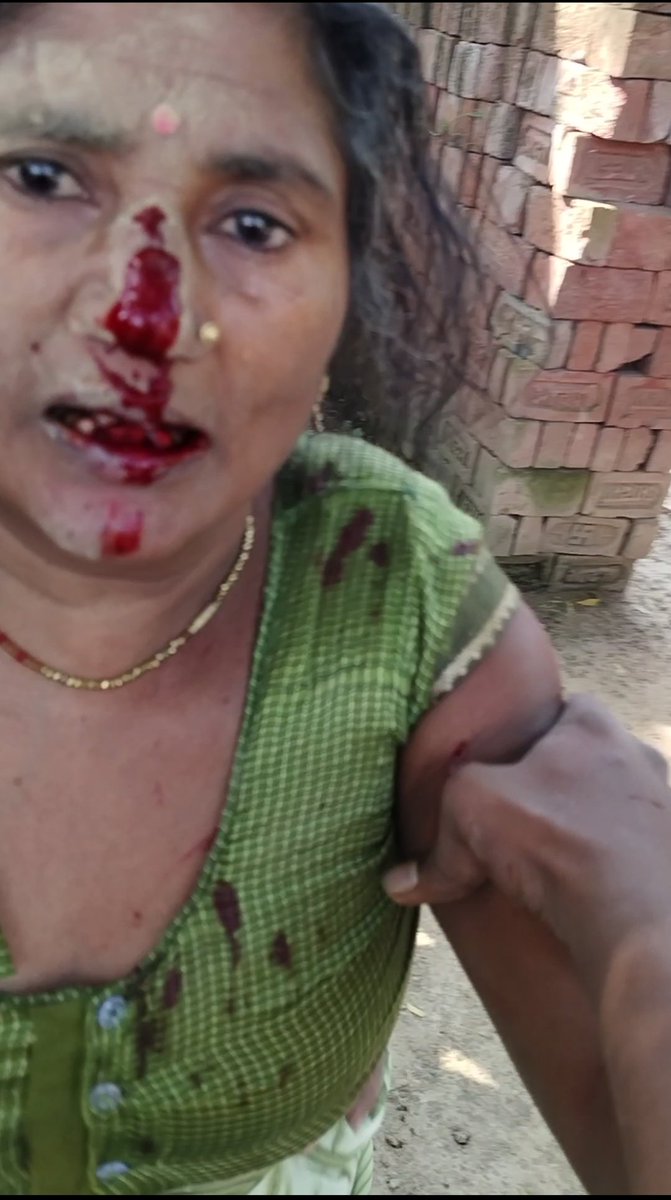 Sandeep68580961's tweet image. #YogiAdityanath #UPCM #जौनपुरपुलिसअधिक्षक #जौनपुरजिलाधिकारी बनीडीह रामपुर जौनपुर मारा पीटा किसी तरह मै वीडियो बना लिया हु वीडियो बनाते समय फोन बचाने के चक्कर में हाथ में लग गया हमारी सुनवाई अभी तक नहीं जांच करने आते हैं अधिकारी झुठी रिपोर्ट लगाते हैं सब अधिकारी सही निस्तारण नहीं