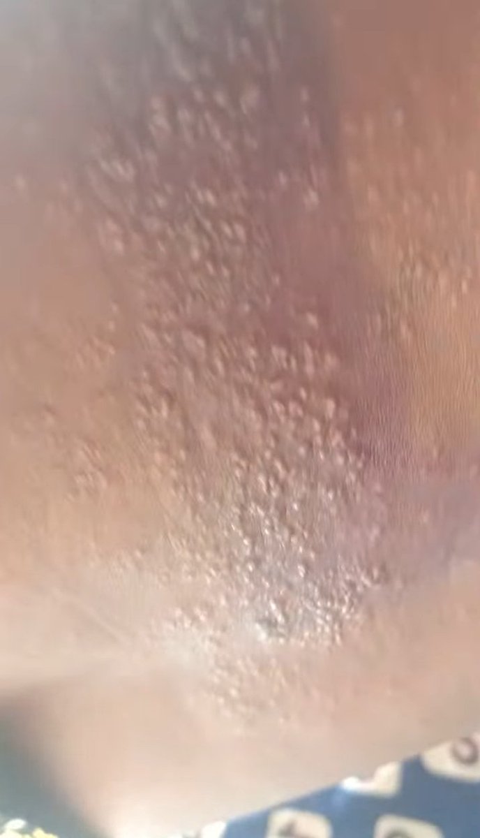 This is very dangerous, if he allows it go round his stomach, I don't think he can survive it, it's has taken so many lives, I have suffered this spiritual sickness and it was cured in a spiritual way, mo doctor's prescribed medicine can cure this, 
This is wen I suffered it