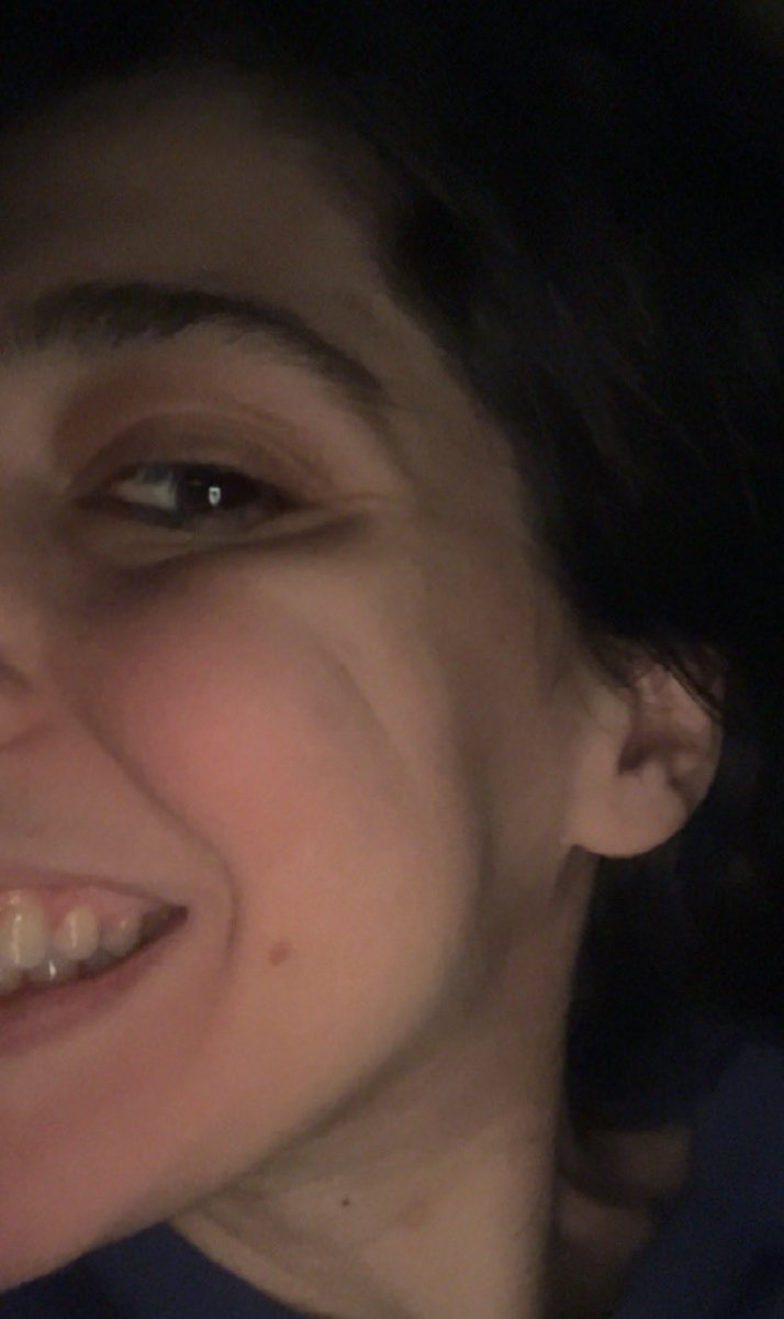 katiamek's tweet image. Is anyone else having TMJ pain / facial pain along with swelling? This is my right side of face. And no that wasn’t my normal before getting sick. It’s really puffy and feels swelled up. It’s the side I have my most pain, migraines. #mecfs #tmj #pwme #longcovid