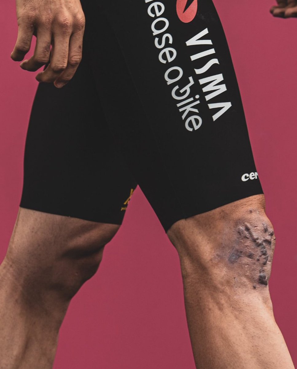 Wout van Aert to ‘The Athletic’:

“Luckily, a lot of my scars are covered when I wear cycling kit, because, unfortunately, there are a lot of them. The knee looks pretty bad. And that makes it a little more difficult, because every time you look down, it reminds you of what