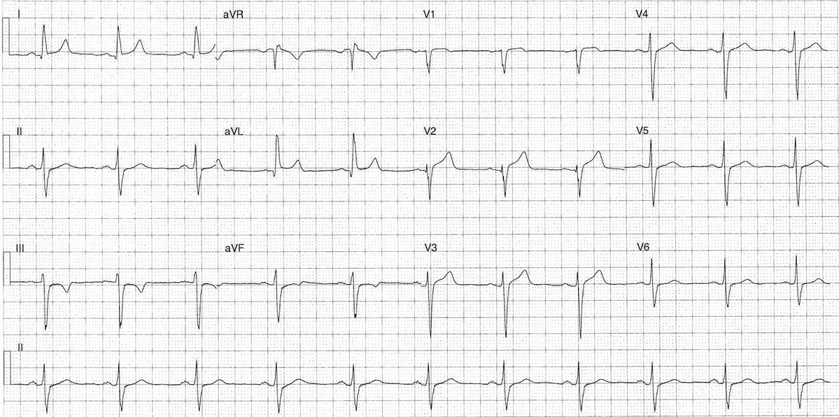 The following ECG is from a 55-year-old male who presented with chest pain. He is a smoker with a history of controlled hypertension.
- What’s your interpretation ?

#medtwitter #foamed #ecg #cardioed