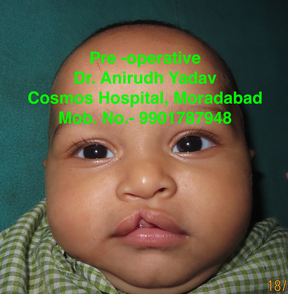 ANIRUDH_UP's tweet photo. #freesurgery #smiletrainindia #cleftlip #cosmoshospital #moradabad https://t.co/nFWvNERj9p