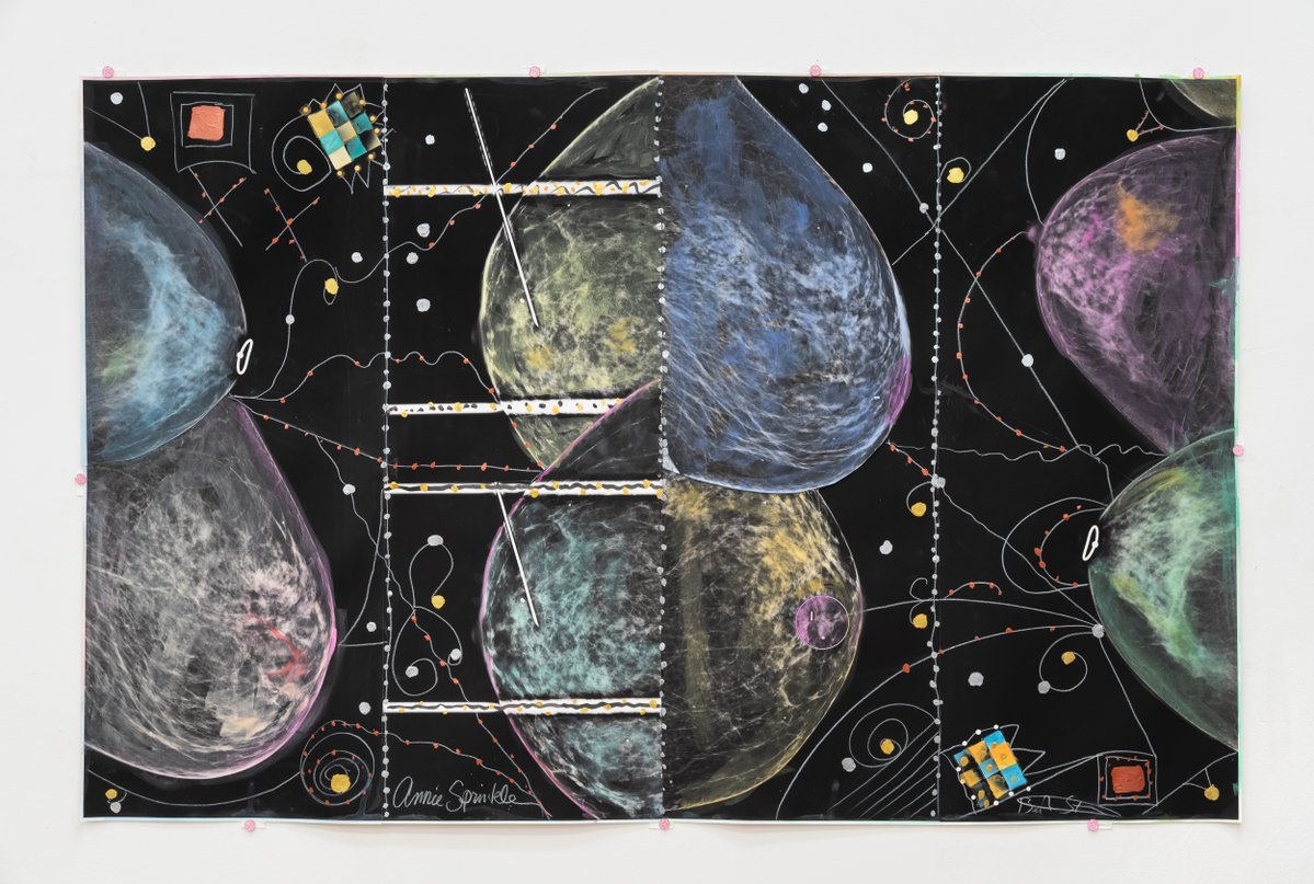 Yesterday I finished radiation on my left boob so should b breast cancer free. I don't "battle" cancer. I love it away! I'm a cancer vixen. I make the best of it, like this painting w my mamogram images. Breast cancer inspired new artworks. I had a radiation vacation celebration!