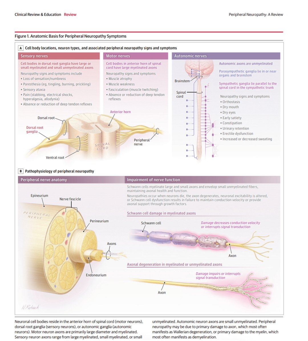 giorg_kyriakos's tweet image. 📘 @JAMA_current review on peripheral #neuropathy.

🧩 ~1% adults worldwide
⚠️ #Diabetes = main cause
🦶 Length-dependent sensory &amp;gt; motor
🧪 Key labs: A1c, B12+MMA, SPEP/IFE
💊 Pain Tx: gabapentin/pregabalin, duloxetine, TCA

🔗 jamanetwork.com/journals/jama/…
#EndoTwitter #MedTwitter